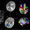 Dit toont hersenscans in de perinatale periode die gebieden die verband houden met autisme benadrukken