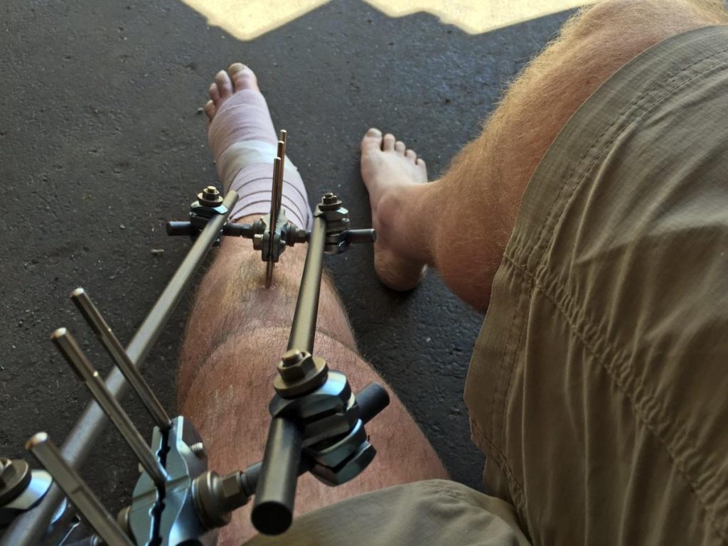 Volgens een rapport leende een man $ 75.000 om een ​​operatie te ondergaan om zijn benen te verlengen om hem 3 centimeter langer te maken