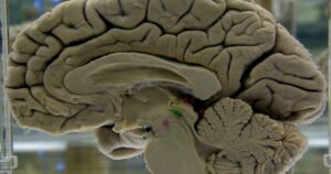 De meeste Amerikanen hechten waarde aan de gezondheid van de hersenen, maar uit een nieuw Alzheimer-rapport blijkt dat weinigen weten hoe ze deze kunnen beschermen