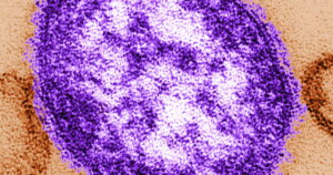 Zesde sterfgeval als gevolg van mazelen gemeld in Franklin County nu de uitbraak in Pennsylvania toeneemt